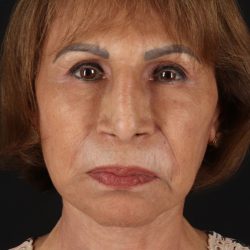 Facelift Before & After Patient #11697