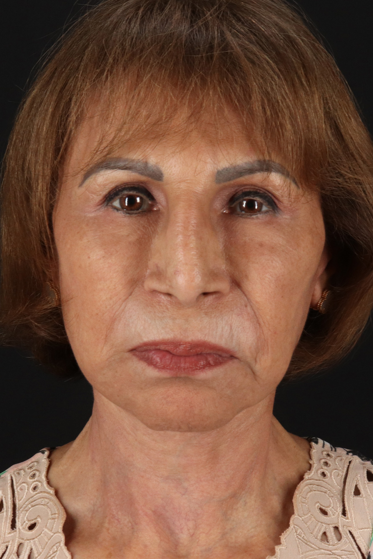 Facelift Before & After Patient #11697