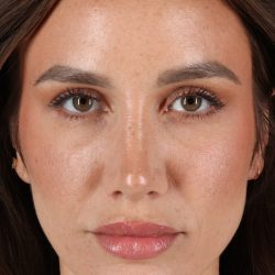 Rhinoplasty Before & After Patient #12370
