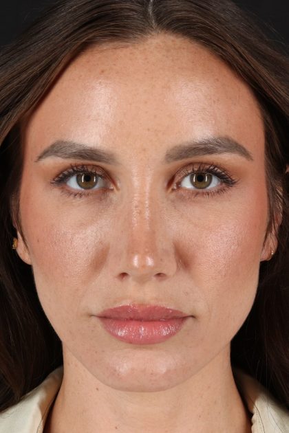 Rhinoplasty Before & After Patient #12370