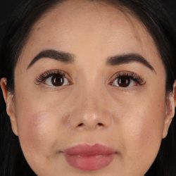 Chin Implant Before & After Patient #13717