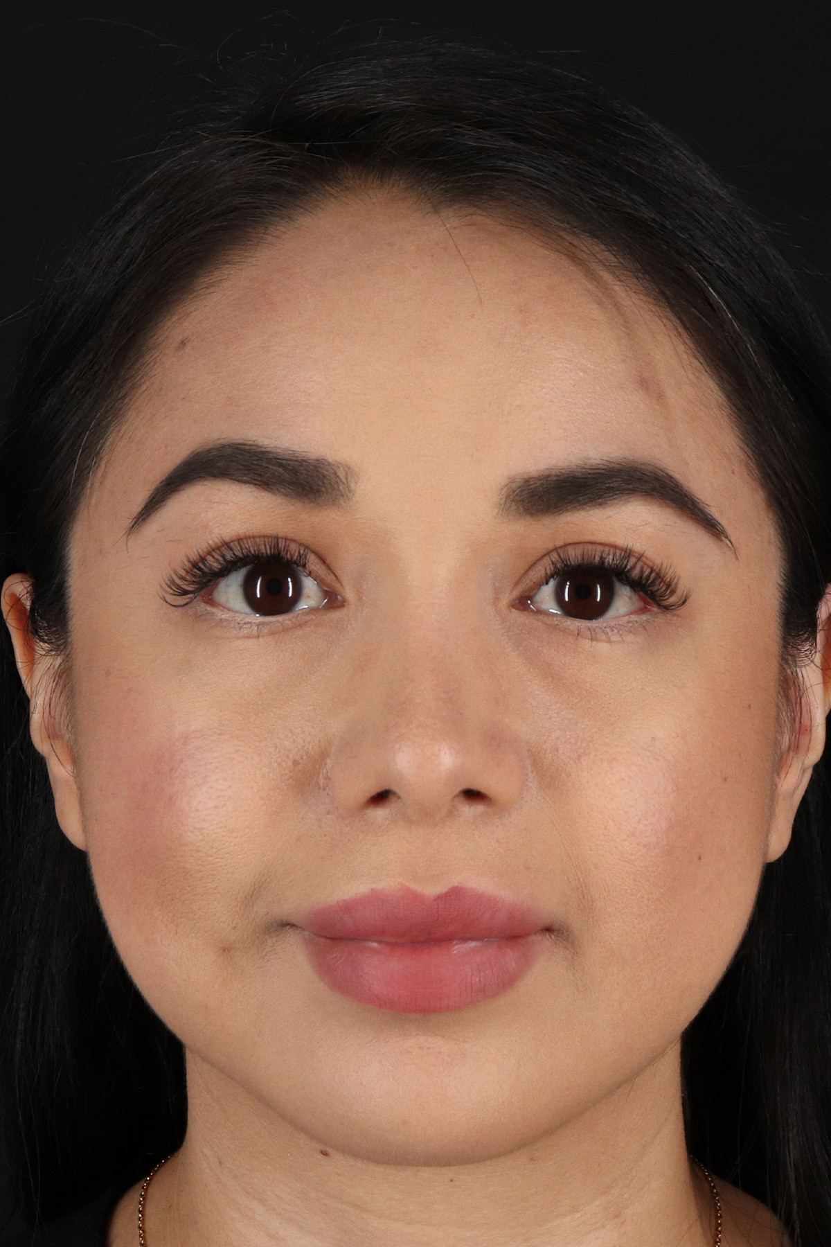 Chin Implant Before & After Patient #13717