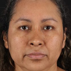 Rhinoplasty Before & After Patient #12293