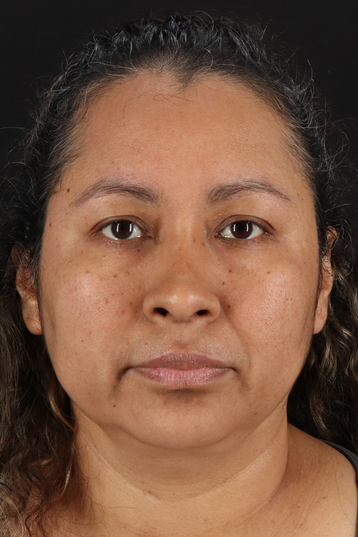 Rhinoplasty Before & After Patient #12293