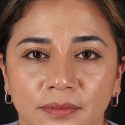 Rhinoplasty Before & After Patient #12425