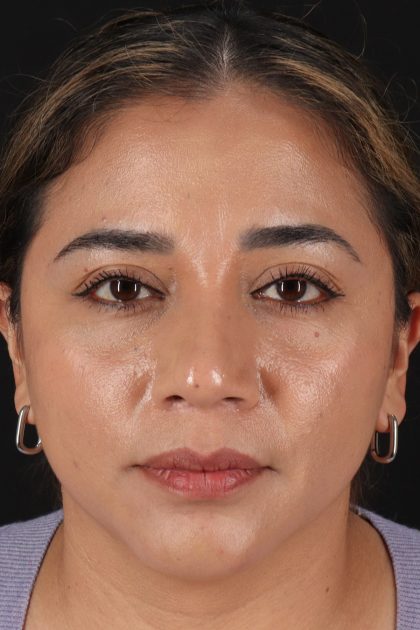 Rhinoplasty Before & After Patient #12425