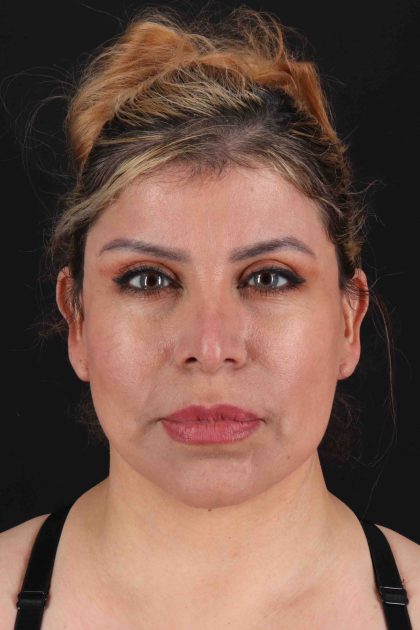 Fat Grafting To The Face Before & After Patient #11850