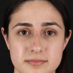 Liquid Rhinoplasty Before & After Patient #11339
