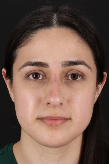 Liquid Rhinoplasty Before & After Patient #11339