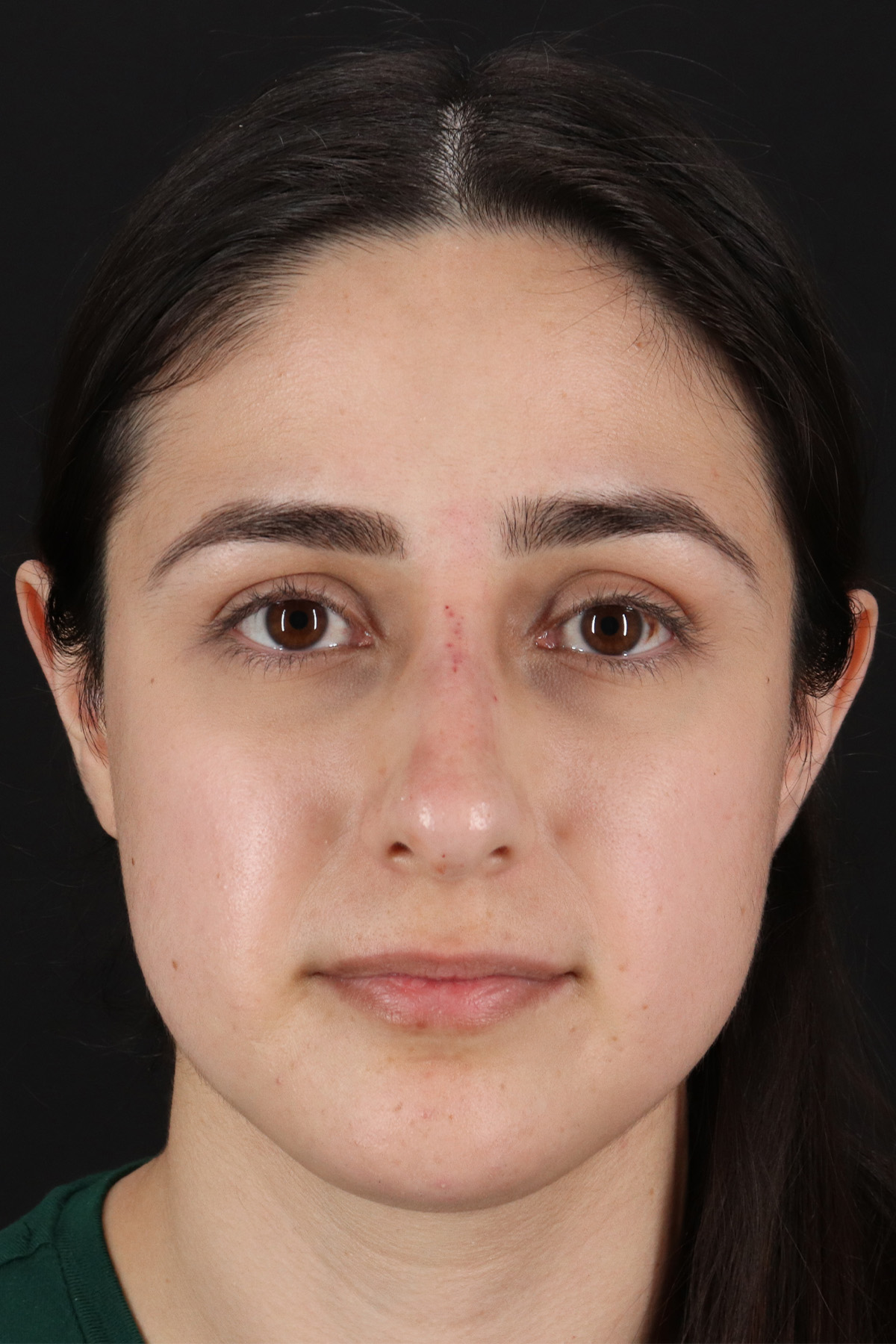 Liquid Rhinoplasty Before & After Patient #11339