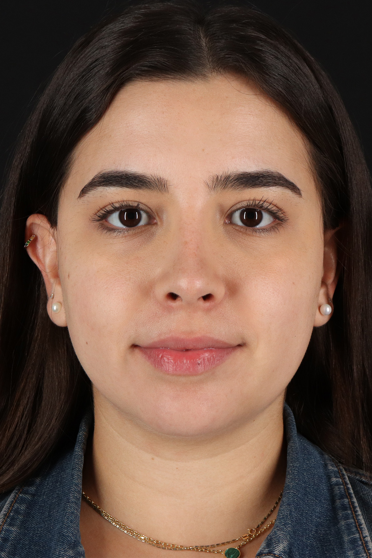 Chin Implant Before & After Patient #11694