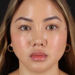 Chin Implant Before & After Patient #13816