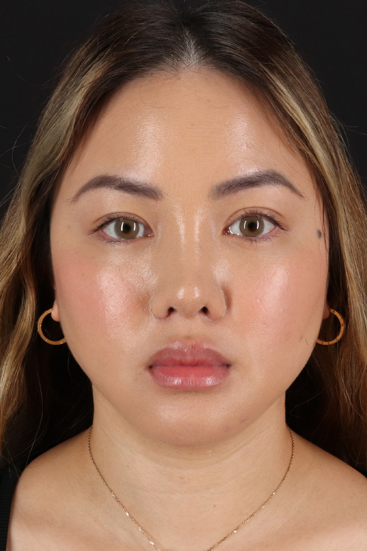 Chin Implant Before & After Patient #13816
