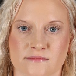 Rhinoplasty Before & After Patient #12381