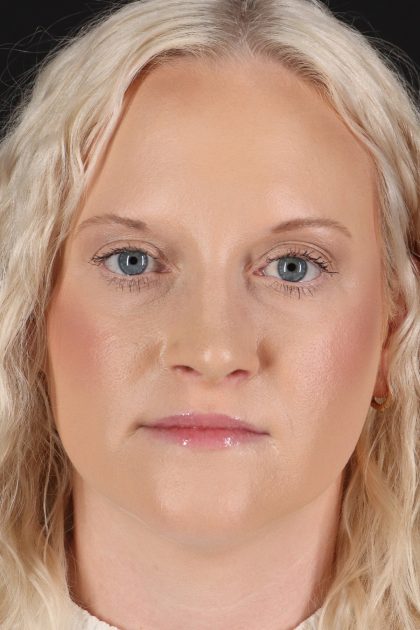 Rhinoplasty Before & After Patient #12381