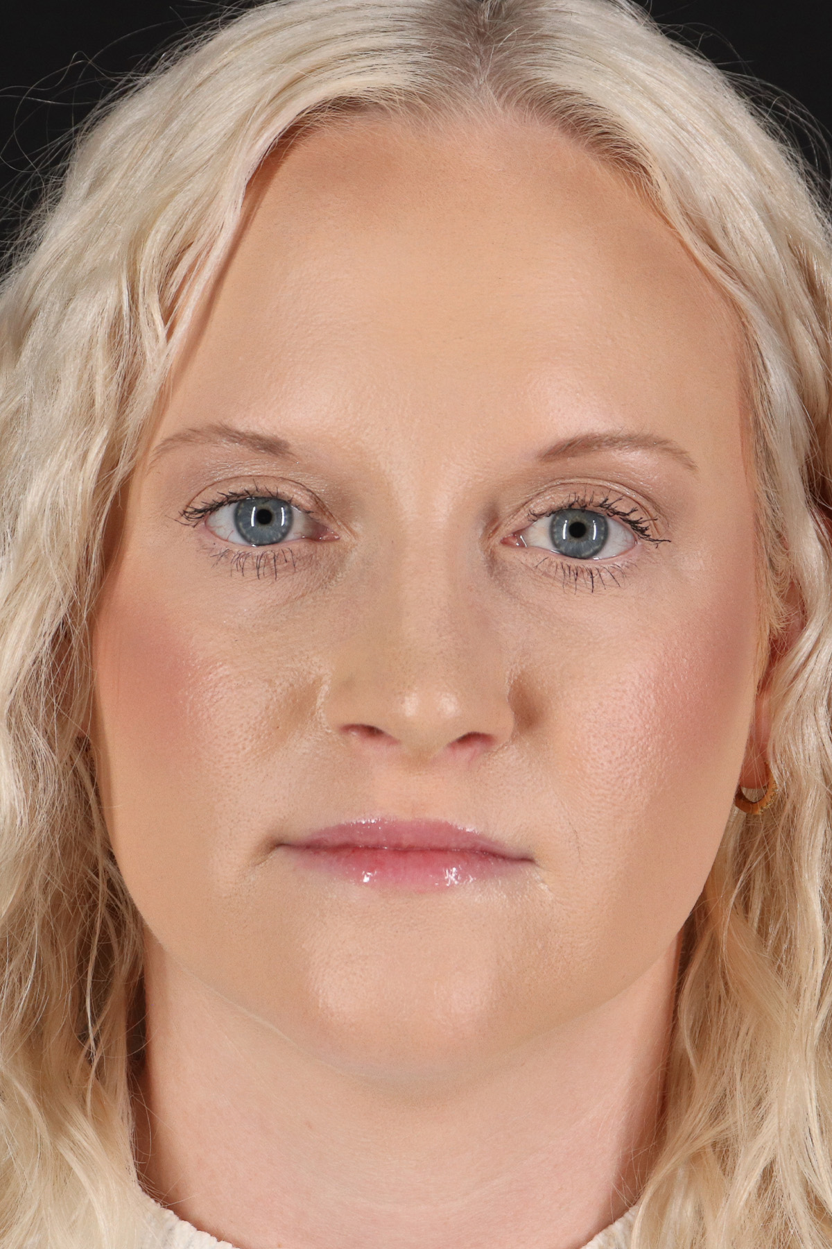 Rhinoplasty Before & After Patient #12381