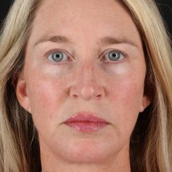Upper Blepharoplasty Before & After Patient #12084
