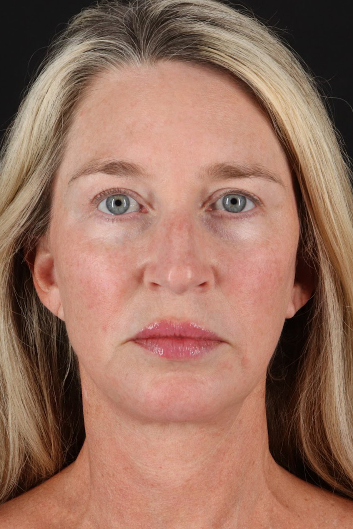 Chin Implant Before & After Patient #13827