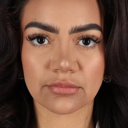 Rhinoplasty Before & After Patient #12326