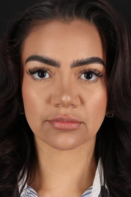 Rhinoplasty Before & After Patient #12326