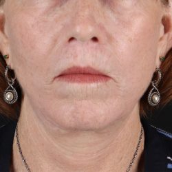 Neck Liposuction Before & After Patient #12117