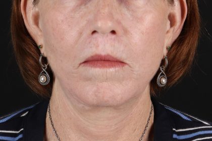 Neck Liposuction Before & After Patient #12117