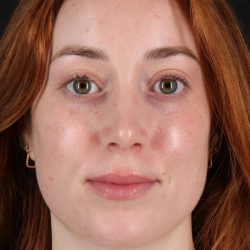 Rhinoplasty Before & After Patient #12348