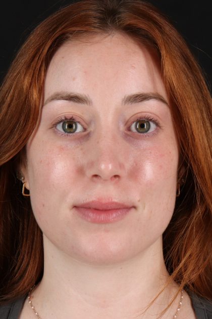 Rhinoplasty Before & After Patient #12348