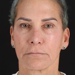 CO2 Laser Before & After Patient #10980