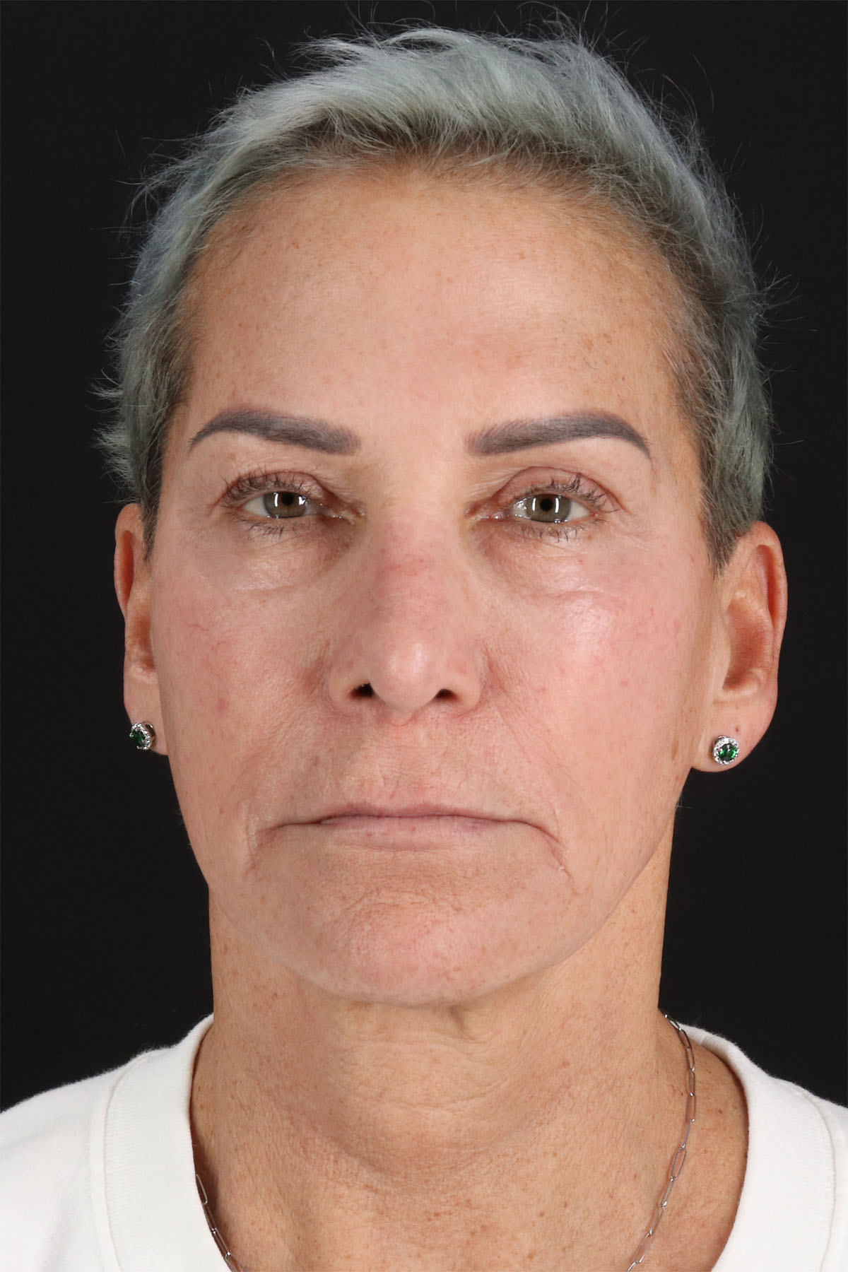 CO2 Laser Before & After Patient #10980