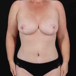 Mommy Makeover Before & After Patient #11938