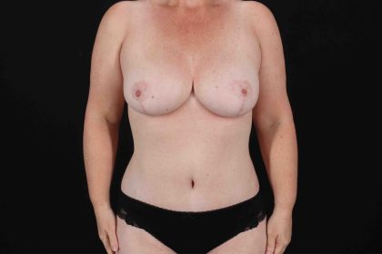 Mommy Makeover Before & After Patient #11938