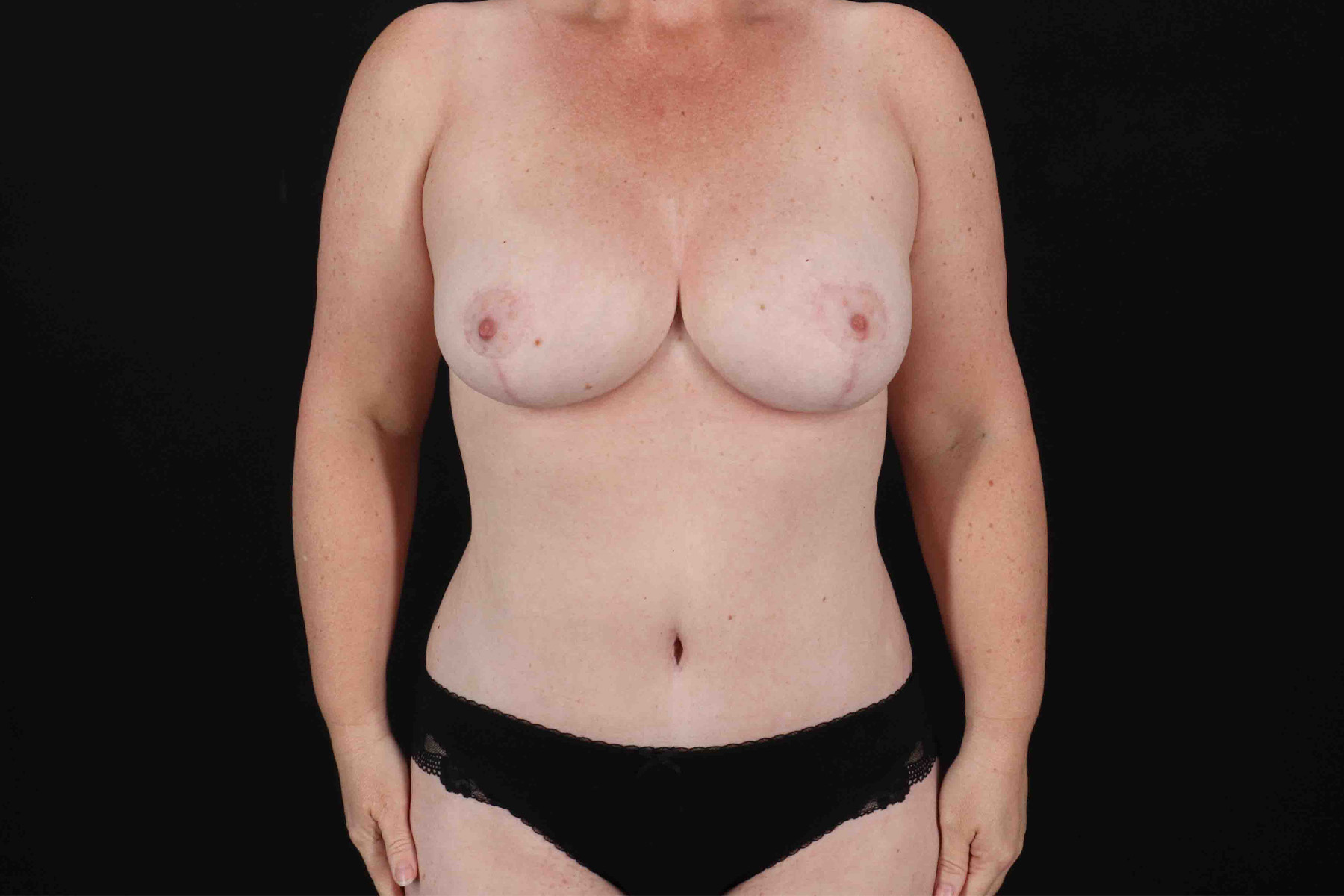 Mommy Makeover Before & After Patient #11938