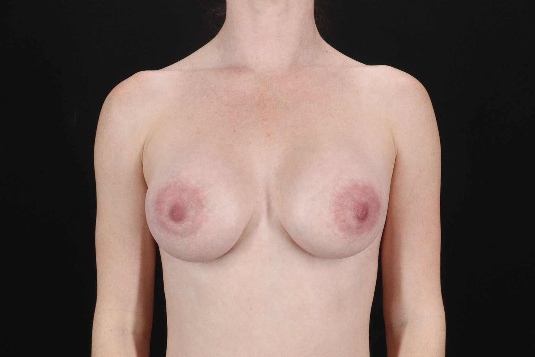 Breast Augmentation with Implants Before & After Patient #10892