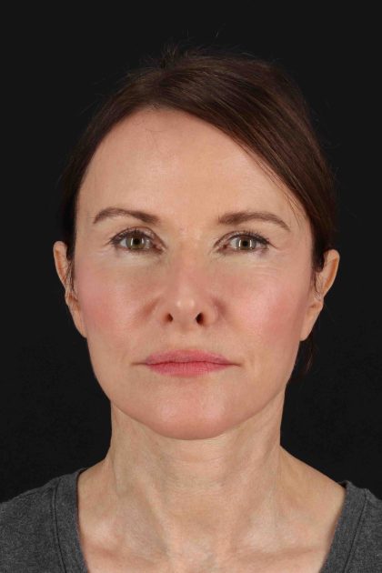 Fat Grafting To The Face Before & After Patient #11839