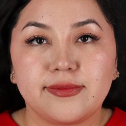 Rhinoplasty Before & After Patient #12447