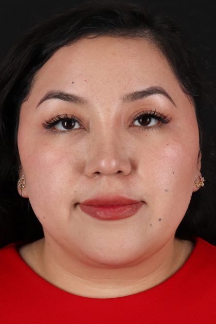 Rhinoplasty Before & After Patient #12447
