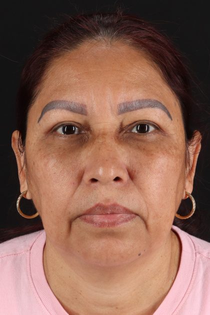 Lower Blepharoplasty Before & After Patient #13085