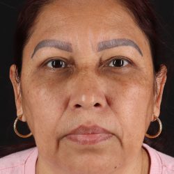 Upper Blepharoplasty Before & After Patient #12051