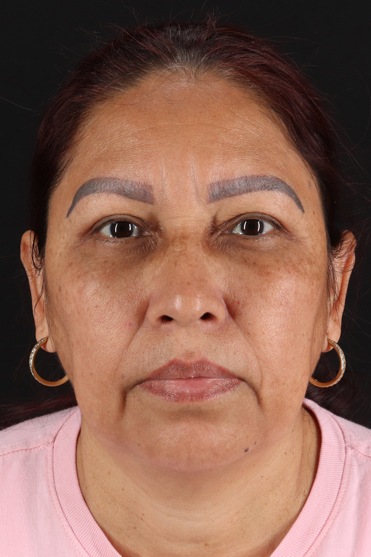 Upper Blepharoplasty Before & After Patient #12051