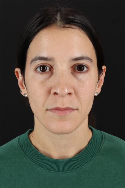 CO2 Laser Before & After Patient #11103