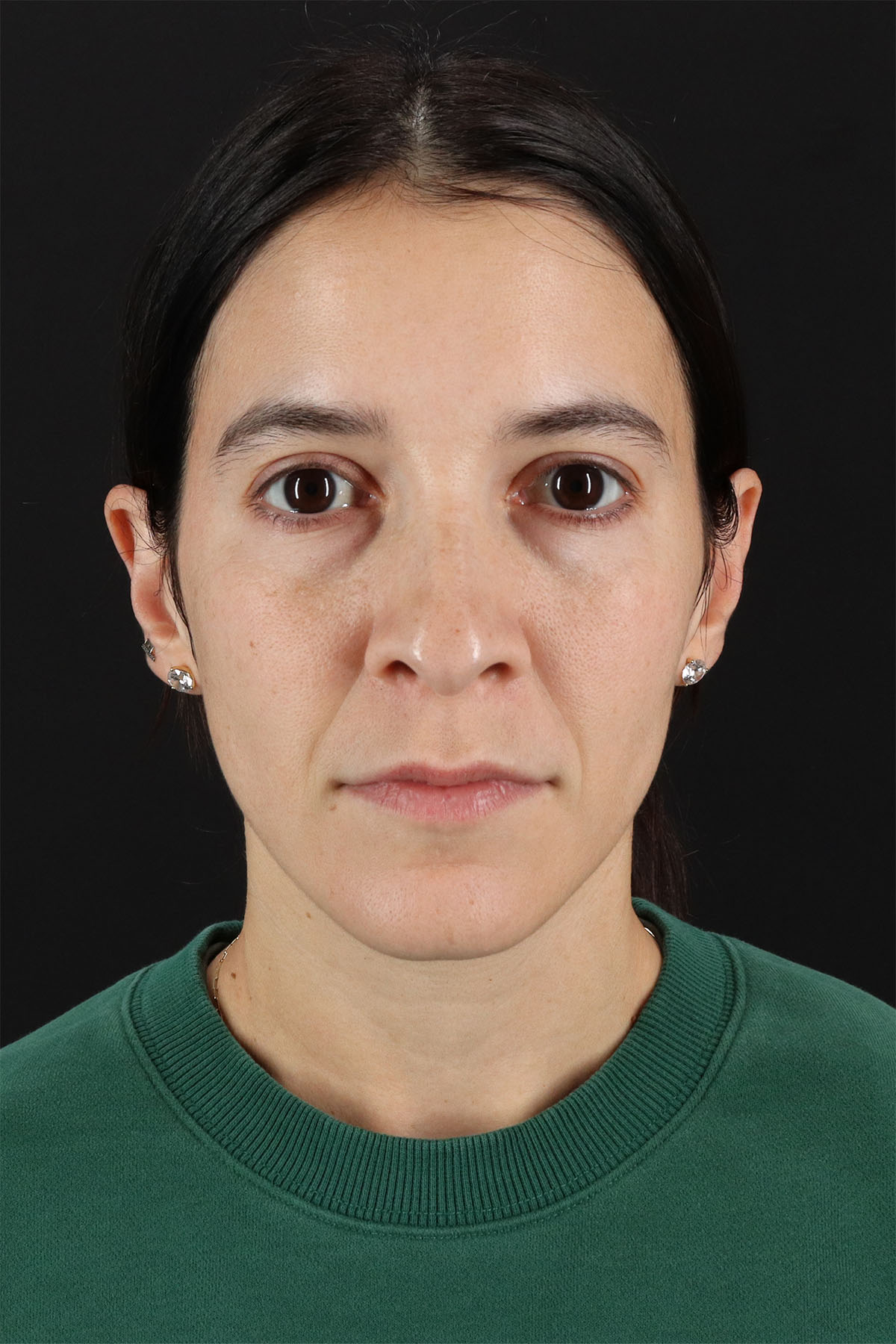 CO2 Laser Before & After Patient #11103