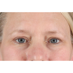 Blepharoplasty (Eyelid Surgery) Before & After Patient #10991