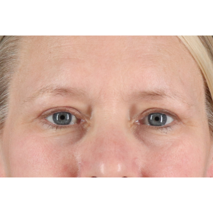 Blepharoplasty (Eyelid Surgery) Before & After Patient #10991