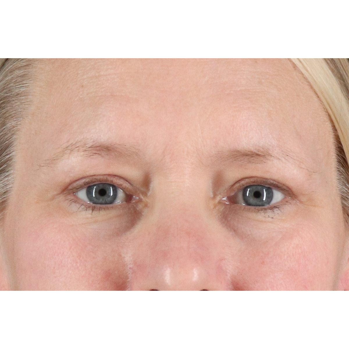 Blepharoplasty (Eyelid Surgery) Before & After Patient #10991