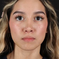 Rhinoplasty Before & After Patient #12216