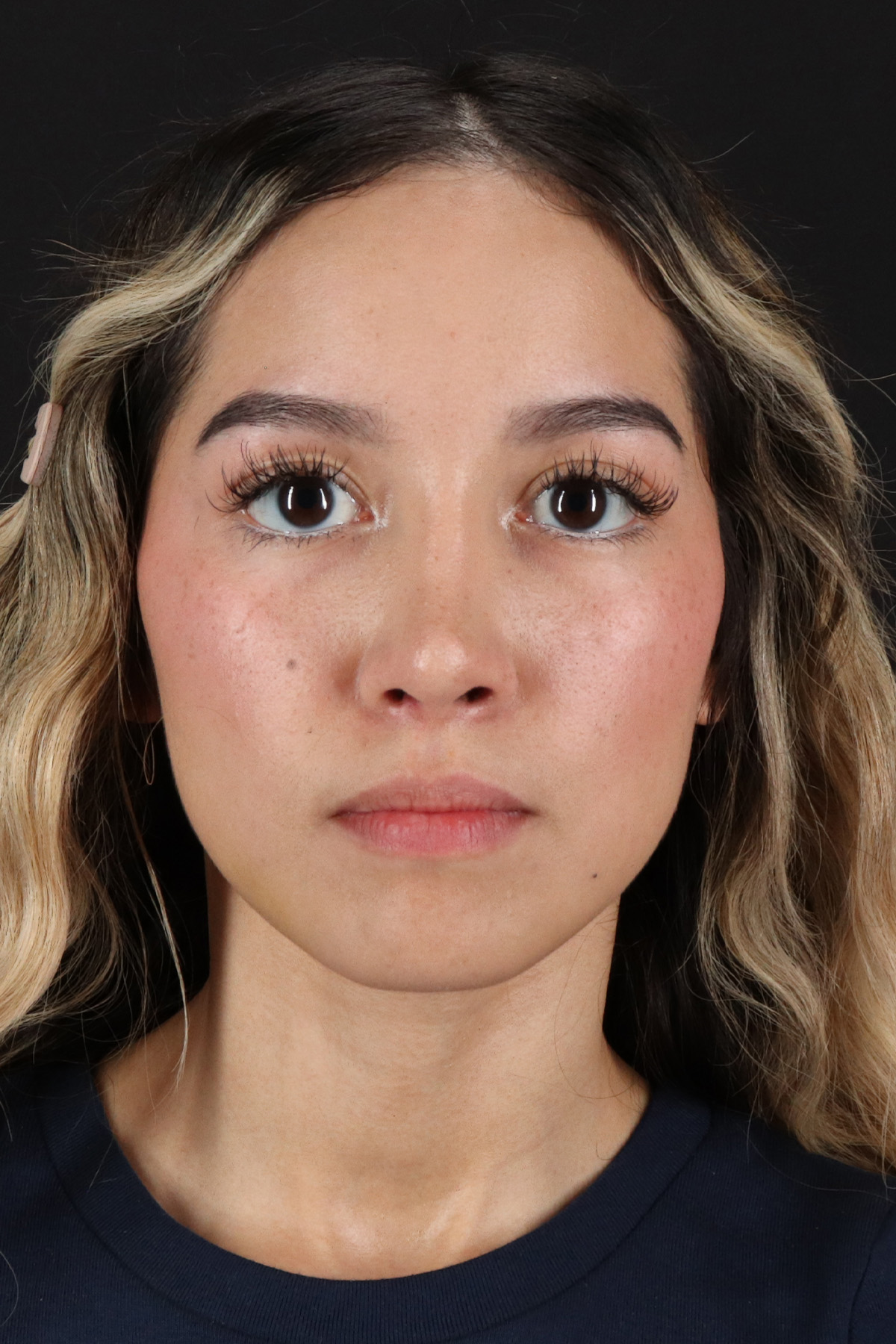 Rhinoplasty Before & After Patient #12216