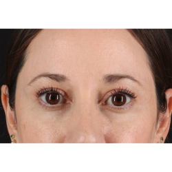 Blepharoplasty (Eyelid Surgery) Before & After Patient #11114