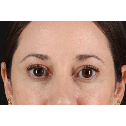Blepharoplasty (Eyelid Surgery) Before & After Patient #11114