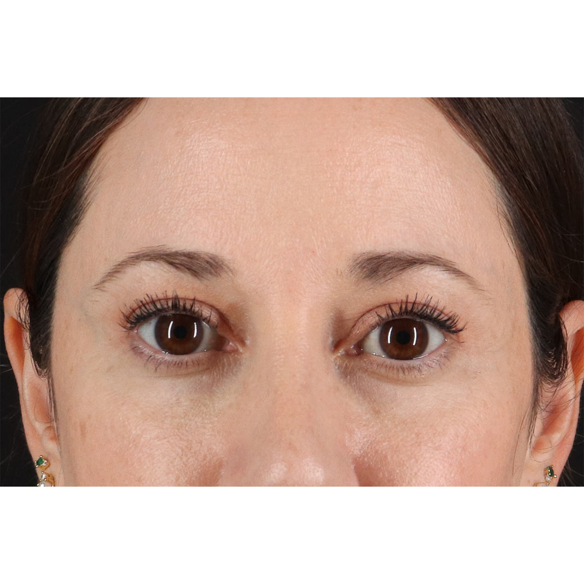 Blepharoplasty (Eyelid Surgery) Before & After Patient #11114